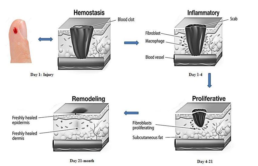 Diagrama esquemático de las cuatro fases de la cicatrización de heridas: hemostasia, inflamatoria, proliferativa y de remodelación.