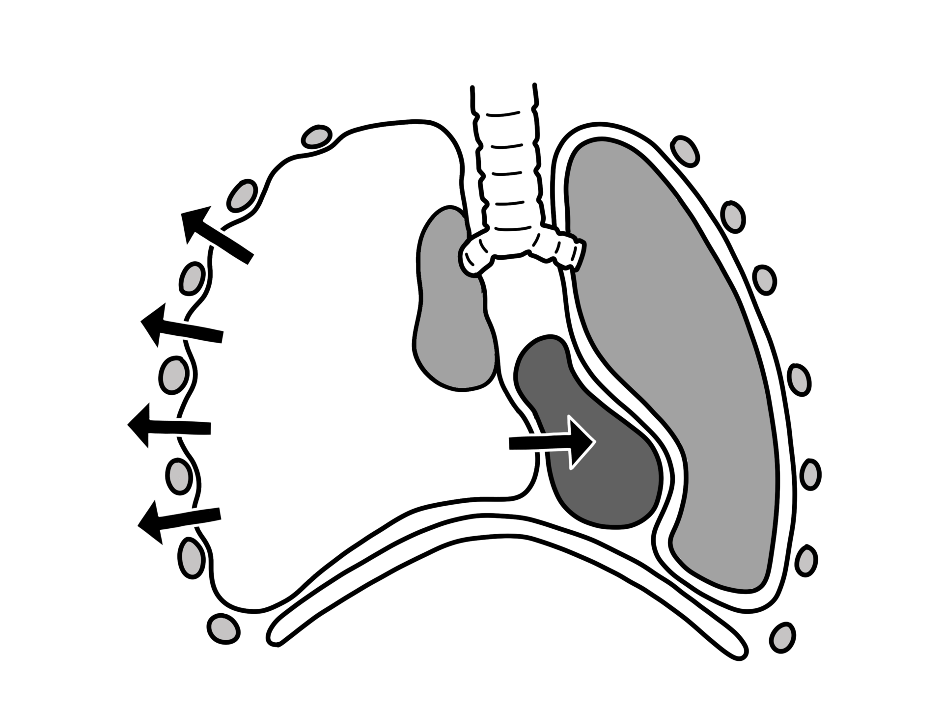 Diagrama de neumotórax a tensión mostrando el colapso pulmonar, el desplazamiento del mediastino hacia el lado contrario y el descenso del diafragma.