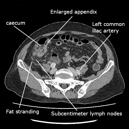 Tomografía computada de abdomen mostrando apendicitis aguda: apéndice engrosado con inflamación de la grasa periapendicular.
