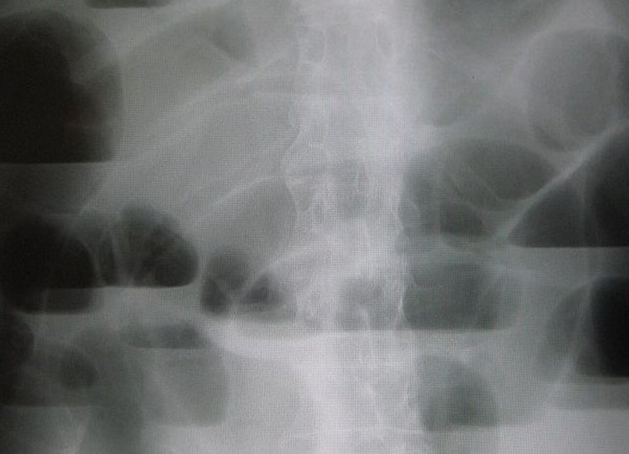 Radiografía simple de abdomen mostrando asas de intestino delgado dilatadas con niveles hidroaéreos, característico de obstrucción intestinal mecánica.