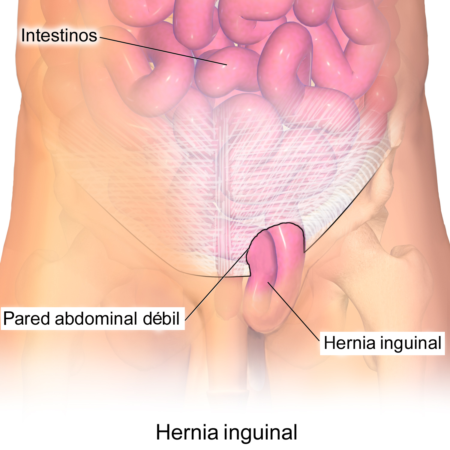 Diagrama del conducto inguinal mostrando su relación con los vasos epigástricos inferiores, el triángulo de Hesselbach y el trayecto del cordón espermático.