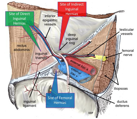 Ilustración de los sitios más frecuentes de hernias de la pared abdominal inferior: inguinal directa, inguinal indirecta, femoral y umbilical.