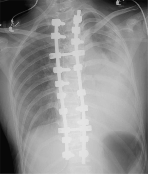 Radiografía de tórax mostrando hemotórax masivo izquierdo, con opacificación completa del hemitórax por acúmulo de sangre en el espacio pleural.
