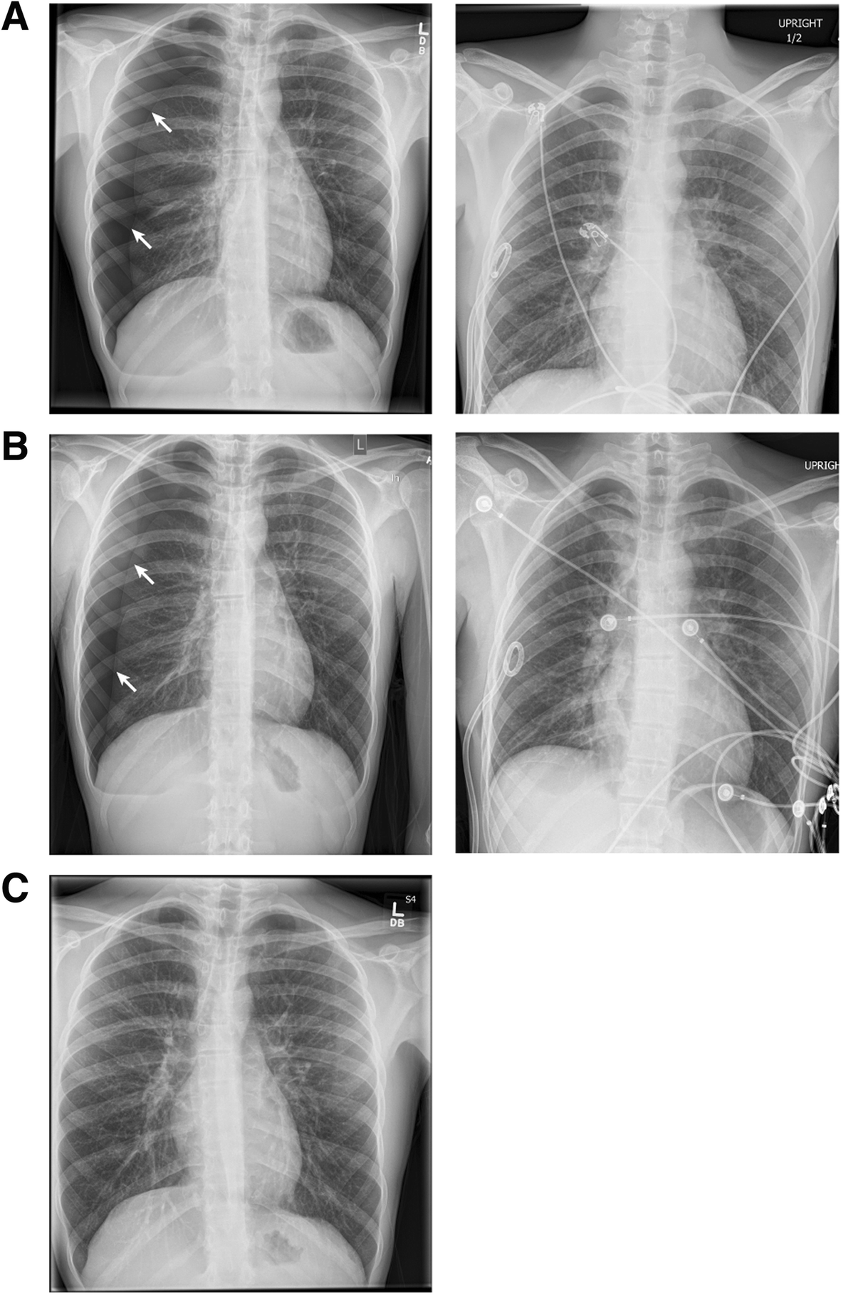 Radiografía de tórax mostrando un neumotórax con la línea de la pleura visceral separada de la pared torácica y ausencia de trama pulmonar periférica.